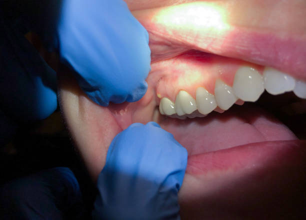 Best Emergency Dental Care for Broken or Chipped Teeth in Isanti, MN